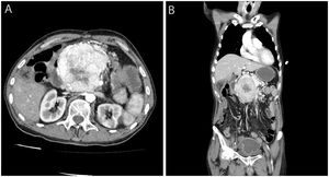 A) Corte transversal de la TAC que muestra tumor hipervascularizado, con necrosis central a nivel de la cabeza del páncreas, sugestivo de tumor neuroendocrino pancreático. B) Corte coronal de la TAC.
