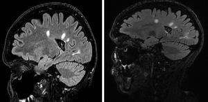RMN cerebral: presencia de lesiones hipercaptantes digitiformes en secuencia FLAIR periventriculares. La imagen de la izquierda corresponde a la RMN al diagnóstico (octubre 2017) y la de la derecha a la RMN de control (junio 2018), sin objetivar aparición de nuevas lesiones desmielinizantes.