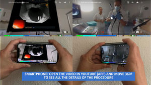 Example of a Smartphone for watching a 360° video using YouTube app. You can move the smartphone in all directions to see all the details of the procedure.