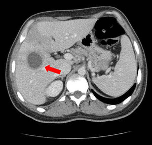 Corte transversal de tomografía computarizada abdominal con contraste intravenoso en que se objetiva lesión ocupante de espacio en hígado compatible con absceso hepático.