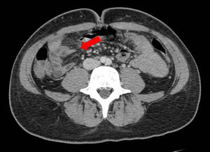 Corte transversal de tomografía computarizada abdominal con contraste intravenoso en que se objetiva engrosamiento de íleon distal.