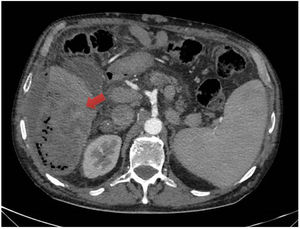 Corte transversal de tomografía computarizada abdominal con contraste intravenoso en la que se observa lesión abscesificada en segmento hepático VI con burbujas de aire en su interior.