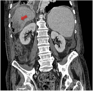 Corte coronal de tomografía computarizada abdominal con contraste intravenoso en la que se objetiva lesión abscesificada que se extiende a espacio perihepático, desde despacio subfrénico a subhepático derechos, con aire en su interior.