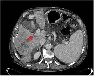 Corte transversal de tomografía computarizada abdominal con contraste intravenoso en la que se observa trombosis de la vena porta derecha compatible con pileflebitis.