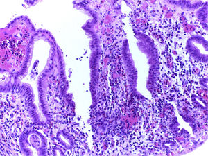 Estudio histológico de biopsia gástrica. Muestra aumento del infiltrado inflamatorio eosinofílico en la lámina propia de la pared del estómago con extensión e infiltración del epitelio foveolar gástrico por eosinófilos.