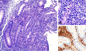 Anatomía patológica: A y B) Hematoxilina-eosina ×10 y ×40: mucosa con ensanchamiento de la lámina propia, celularidad de amplio núcleo redondeado y basófilo. C) C-kit (CD117) ×20: tinción inmunohistoquímica citoplasmática con práctica totalidad de la celularidad inflamatoria (mastocitos).