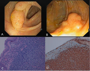 A Multiple small yellowish polyps covered by normal mucosa were found along all colonic segments, from cecal region to rectum. B. A large polypoid lesion with approximately 25mm was identified at the cecum and removed by endoscopic mucosal resection. C. A monomorphic infiltration of mucosa and submucosa by small-sized atypical lymphoid cells may be seen. These cells are characterized by irregular nuclei and scant cytoplasm and demonstrate a nodular infiltrative growth pattern (HE, 200×). D. Immunohistochemistry showing positive stain for cyclin D1.