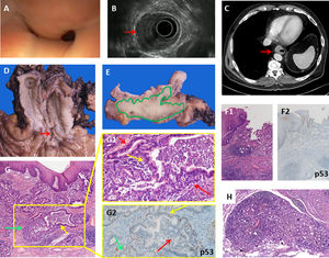 A: Endoscopic view of the stenosis of the distal esophagus covered with normal mucosa. B: Endoscopic Ultrasound (EUS) showing a tumor in the esophageal wall infiltrating the muscular layer (red arrow), but sparing the mucosal layer, and affecting 50% of the circumference. C: CT scan showing mural thickening of the distal esophagus (red arrow). D: Gross findings: a longitudinal erosion in the lower esophagic mucosa (red arrow), with no Barrett