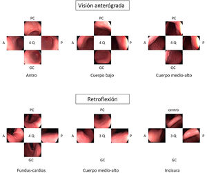 Mapeo fotográfico siguiendo el Systematic Screening Protocol for the Stomach (SSS) para la vigilancia de lesiones precursoras de cáncer gástrico.