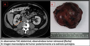 A) TAC abdominal observándose tumor retrocaval (flecha). B) Imagen macroscópica del tumor posterior a la exéresis quirúrgica.