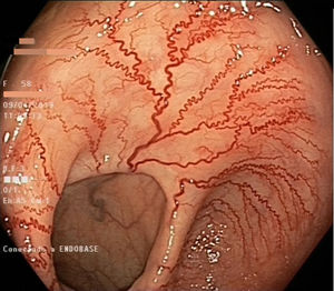 Colonoscopia. Área adyacente a la anastomosis quirúrgica con abundantes neoformaciones vasculares.