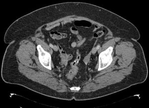 Tomografía computarizada (TC) de abdomen. Anastomosis quirúrgica (material quirúrgico metálico), sin datos de recidiva local.
