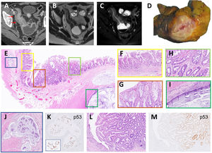 (A) Contrast enhanced CT in venous phase showed severe mural oedema and hyperenhancement of a long segment of the distal ileum that was also stenotic. Fat stranding of the perienteric fat and the comb sign were also visible. Upstream dilatation of the small bowel was present. (B, C) Axial MRI T2 weighted images without (B) and with fat saturation (C) confirmed the CT findings and indicate intramural oedema. (D) Cross section of the intestinal wall showed a narrow lumen and wall thickening. (E) Panoramic section of the thickened bowel wall showing various lesions. (F) Flattened villi and complex architectural glands as signs of chronicity of CD. (G) Detail of serrated glands with LGD in a SEL. (H) Serrated glands with HGD in the other side of the same SEL. (I) Mucinous adenocarcinoma infiltrating the bowel wall as pools of mucin covered by a monolayer of atypical cells. (J) Lymphovascular invasion by mucin with signet-ring cells. (K) The same signet-ring cells showed nuclear p53 expression. (L) Linear ulcer in an area of active CD and adjacent another polypoid SEL. (M) p53 staining was observed in glands with HGD.