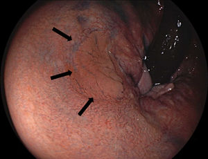 Colonoscopy showing a 12mm non-granular flat lesion in the rectum, at 3cm from the anal verge.