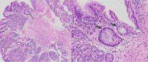 Biopsies showing fragments of fundic gastric mucosa along with unaltered colonic mucosa.