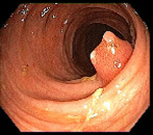 Imagen endoscópica de un adenoma de glándulas pilóricas en colon transverso.