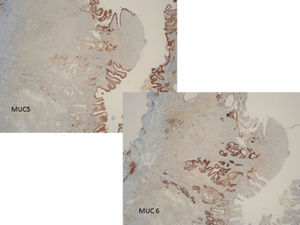 Tinción inmunohistoquímica que muestra expresión de MUC5 en la superficie y MUC6 en las glándulas profundas.