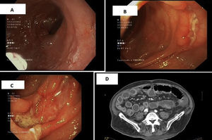 Imágenes endoscópicas y radiológicas de la yeyunitis ulcerativa. A) Atrofia vellositaria en segunda porción duodenal. B y C) Úlceras yeyunales profundas de tamaño variable. D) Imagen de TC en que se aprecia edema y engrosamiento mural de yeyuno.