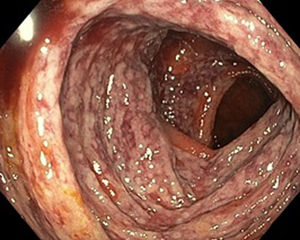 En la endoscopia se observa afectación continua de la mucosa con edema, eritema petequial y subfusiones hemorrágicas.