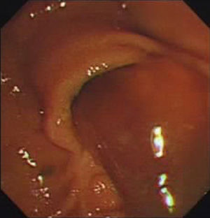 ERCP showed the classic “fish-eye appearance” at the ampulla of Vater and excessive mucous discharge from the papilla.