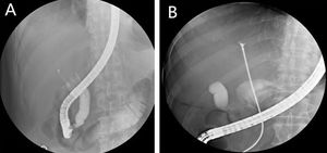 (A) Cholangioscopy showed persistent biliary dilations and irregular filling defects despite vigorous washing. (B) Bile duct biopsy was performed under fluoroscopy.
