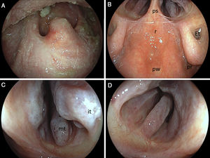 (A) Post-biopsy scar formation in the hard palate close to the uvula. (B) A panorama view of the backside of the nasal cavity (posterior rhinoscopy: pw, posterior nasopharyngeal wall; r, nasopharyngeal roof; ps, posterior septum; Et, Eustachian tube opening; pr, pharyngeal recess/fossa of Rosenmüller). (C) Close-up view of the right and (D) left nasal passage: it, inferior; mt, middle turbinate – note marked turbinate/conchae hypertrophy.