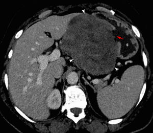 Axial-view contrast-enhanced CT reveals a large ulcerated (red arrow), well-defined, heterogeneously enhancing mass (arrowheads) on the lesser curvature of the stomach (S), occupying the lesser sac.