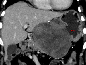 Coronal-view contrast-enhanced CT shows that mass is associated with loss of fat planes with the pancreas body (P).