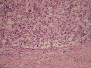High power photomicrograph shows pleomorphic spindle cells of high grade sarcoma with occasional lipoblasts (stain, hematoxylin and eosin).