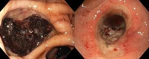 Prepyloric gastric ulcer, Forrest IIb (left); circumferential duodenal ulcer Forrest IIc (right).