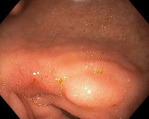 Prepyloric gastric ulcer, almost complete, resolution after 3 months endoscopic follow up.