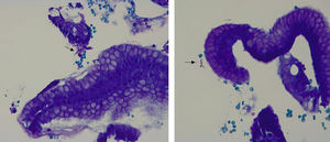 Gastric biopsy samples with bacteria lengthier than H. pylori, stained with modified giemsa (400×), corresponding to Helicobacter heilmannii S.l. specimens (arrows).