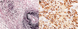 A) Imagen microscópica de la pieza quirúrgica pancreática donde se identifica fibrosis intersticial difusa esteriforme, flebitis obliterativa e intenso infiltrado inflamatorio de linfocitos T (A) junto a gran positividad para células plasmáticas IgG4 (B).
