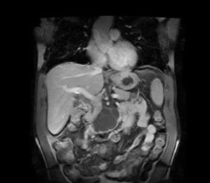 Imagen de TAC donde se observa lesión quística tabicada en proceso uncinado pancreático.