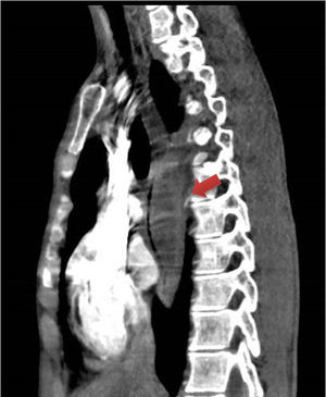 Corte sagital de tomografía computarizada torácica con contraste intravenoso en la que se observa colección paravertebral de morfología fusiforme, con leve realce periférico, que condiciona efecto masa sobre esófago.