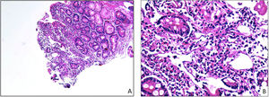 Imagen histopatológica de biopsias duodenales con linfangiectasia. A) Microfotografía en aumento intermedio (×10) en la que se puede apreciar un fragmento de mucosa duodenal con linfangiectasia. Note el edema y la dilatación linfática observada en la zona central de la imagen. B) Microfotografía en gran aumento (×40) en la que se puede apreciar un fragmento de la mucosa duodenal afectada por la linfangiectasia. Note el infiltrado inflamatorio linfoplasmocitario de su lámina propia, así como la presencia de vasos linfáticos tortuosos y dilatados.