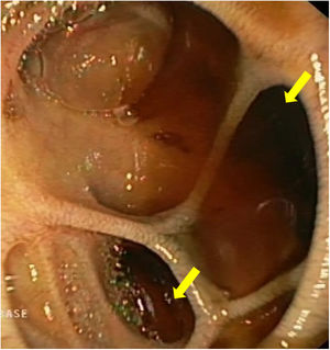 Múltiples divertículos.