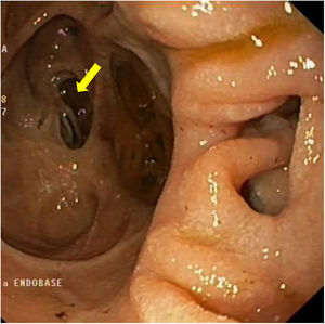 Múltiples divertículos.