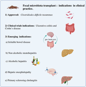 Fecal microbiota transplant: Clinical indications.