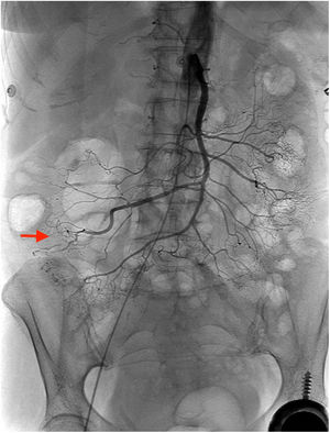 Imagen arteriográfica después de la embolización.