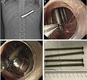 (A) Abdominal imaging showed several long rods in the stomach. (B) We failed to remove the nails using a grasping forceps. (C) The inserted magnets and the retained nails were binded together for extraction. (D) The four nails were removed and were about 10cm in length.