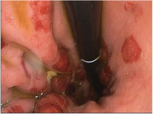 Imagen endoscópica, objetivándose nódulos violáceos sobreelevados en cuerpo gástrico.