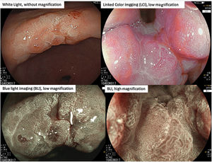 0-IIa+IIc early gastric cancer at the incisura, with an irregular distribution of White Opaque Substance as seen with white light, LCI and BLI.
