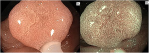 0-Is colonic adenoma with White Opaque Substance, seen with white light and NBI with near focus.
