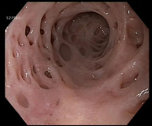 2. Imagen endoscópica de la pseudodiverticulosis esofágica.