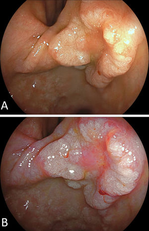 (A) An estimated 30-mm Paris 0-IIa+IIc lesion at the anterior gastric angle with an elevated circumferential protruberance. (B) Linked colour imaging (LCI) highlights the irregular central redness (or rather pinkness) and well-preserved demarcation to the surrounding mucosa. Nonetheless, the probability of submucosal infiltration and high-grade fibrosis was considered high.
