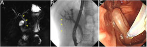 (A) Magnetic resonance cholangiography showed a hypo intense strip in the common and right intrahepatic bile ducts. (B) ERCP revealed a long strip filling defect in the right posterior intrahepatic bile duct. (C) The ascaris was extracted by a wire-guided basket.