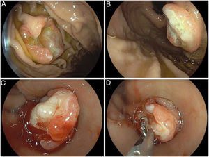 (A, B) Endoscopic visualization of two elevated nodular lesions with ulceration in the proximal stomach highly suggestive of gastric metastases, in part, easily accessible by standard biopsy (lesion in A) and another difficult-to-biopsy lesion (B) due to an overly tangential approach. (C, D) Cap-fitted endoscopy using a long-hooded cap with lesion stabilization after judicious suctioning with subsequent targeted “intra-cap biopsy” as a novel approach for difficult-to-access gastrointestinal lesions.
