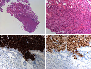 (A, B) Dense infiltration by malignant cells with anisomorphic and basophilic nuclei (H&E, ×2.5 and ×10, respectively). Dedicated immunohistochemistries revealing marked melan A (C) and SOX-10 (D) expression confirmative of gastric melanoma metastases (each ×10 – not shown immunohistochemistry for CK-18 negative).