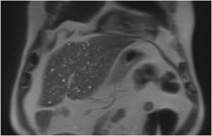 Múltiples imágenes de apariencia microquística en el parénquima hepático.